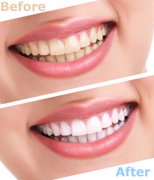 Teeth Whitening in Buffalo, NY | Affordable Tooth Whitening Dentist