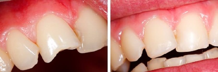Teeth Bonding – A Fast and Cheap Way to Get Your Teeth Straight and White, Cosmetic Dentistry & General Dentistry located in Chesterfield, MO